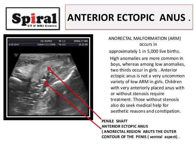 Anterior displaced anus photo 70
